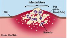 Drainage of an arm MRSA abscess (VIDEO)