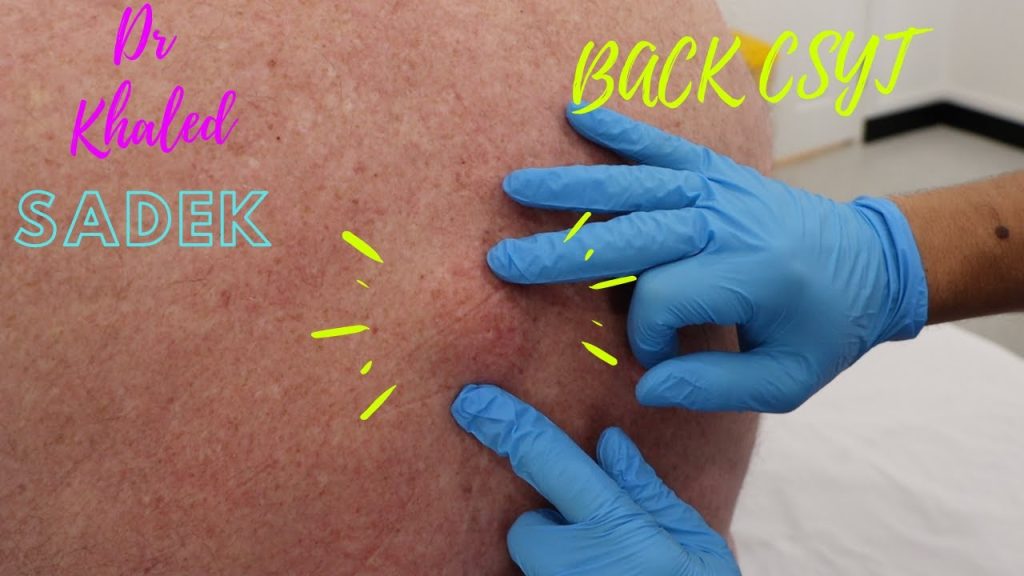 Must-See: Deep Blackhead Removal Techniques Exposed - Top Stories