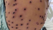 Patient with an unusual rash. What’s the diagnosis?