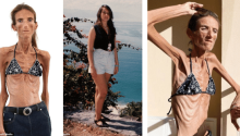 World’s Thinnest Woman Receives Fan Mail to Be Like Her