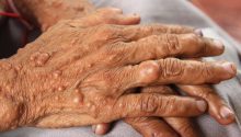 Understanding Neurofibromatosis Type 1 (NF1): Causes, Symptoms & Treatment
