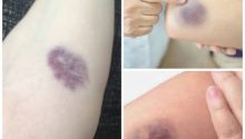 Understanding Red Bumps: What They Mean for Your Skin