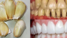 Improve Your Oral Health Naturally with Garlic
