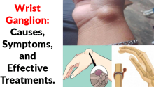 Wrist Ganglion: Causes, Symptoms, and Effective Treatments.