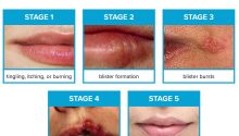 Everything You Need to Know About Those Pesky Little Blisters