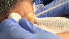 Large Cyst Squirts and Oozes from Patient’s Neck (VIDEO)