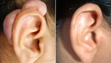 Keloid Removal Explained: Treatment Options and Real Procedure Video