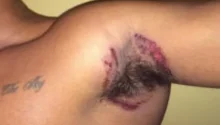 Lawsuit blames Old Spice deodorant for severe armpit rashes (VIDEO)