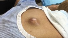 Removal of Infected Cyst on Mid-back: Watch the Procedure