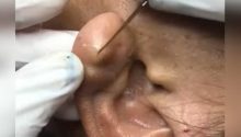 Doctor Pops a Hidden Earlobe Cyst – So Satisfying (VIDEO)