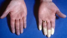 Raynaud’s Disease: Causes, Symptoms, and Management Tips