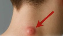 Got a lump on your neck, back or behind your ear? Then you need to know that