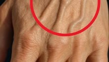 What the Veins on Your Hands Might Reveal About Your Kidney Health